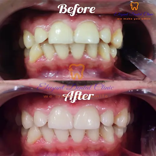 dental-cleaning-and-polishing.webp
