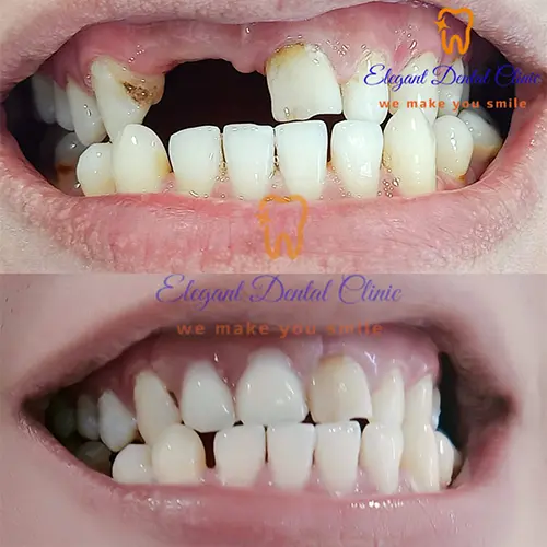 dental-implants.webp