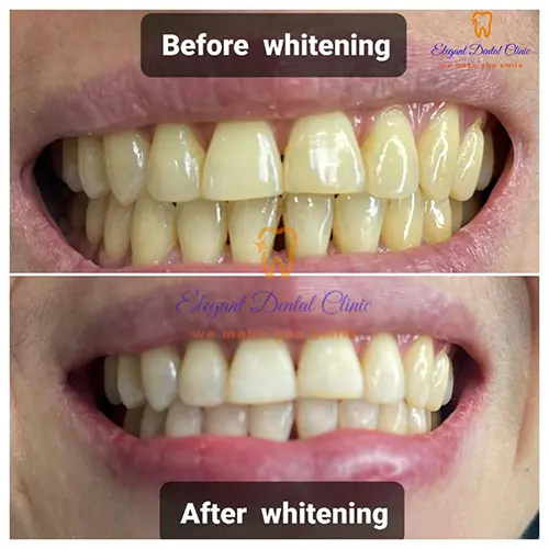 dental-whitening.webp