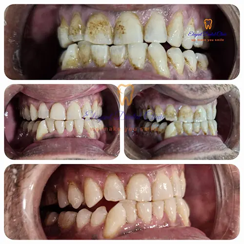 tooth-extraction.webp